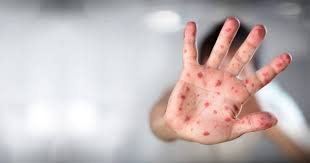 10 vezes mais casos de sarampo na Europa em 2024: e a culpa também foi do Trump?