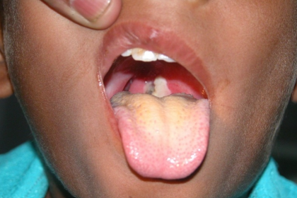O caso mortal de difteria em Itália: entre o antivacinismo dogmático e o vacinismo zelota