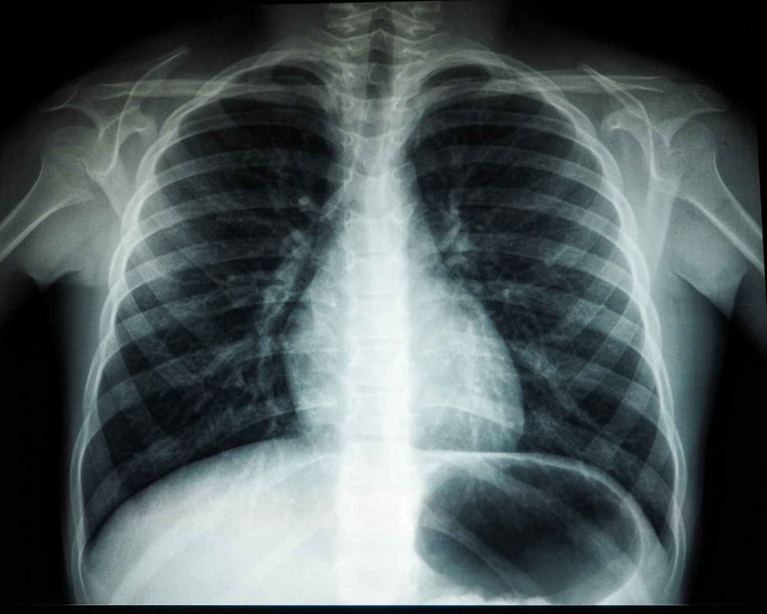 Pneumonia: em duas décadas, internamentos cresceram 93%, mas médicos especialistas aumentaram apenas 44%
